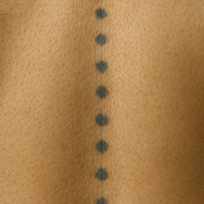 A drawing depicting dotted tattoo patterns placed along the spine for therapeutic purposes.